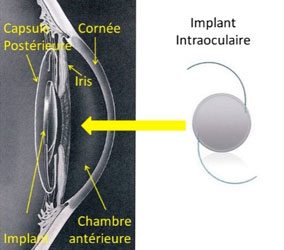 Cataracte