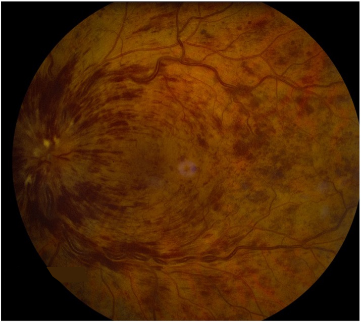 Occlusion veineuse rétinienne