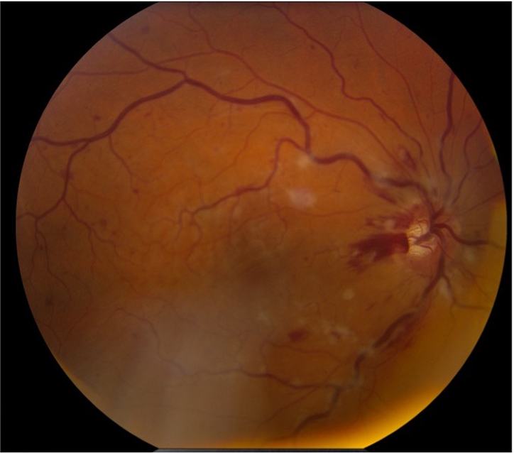 Occlusion veineuse rétinienne