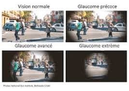 Glaucome