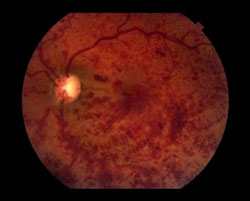 Occlusion veineuse rétinienne